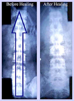 Prima e dopo trattamento con pranoterapia su spina dorsale